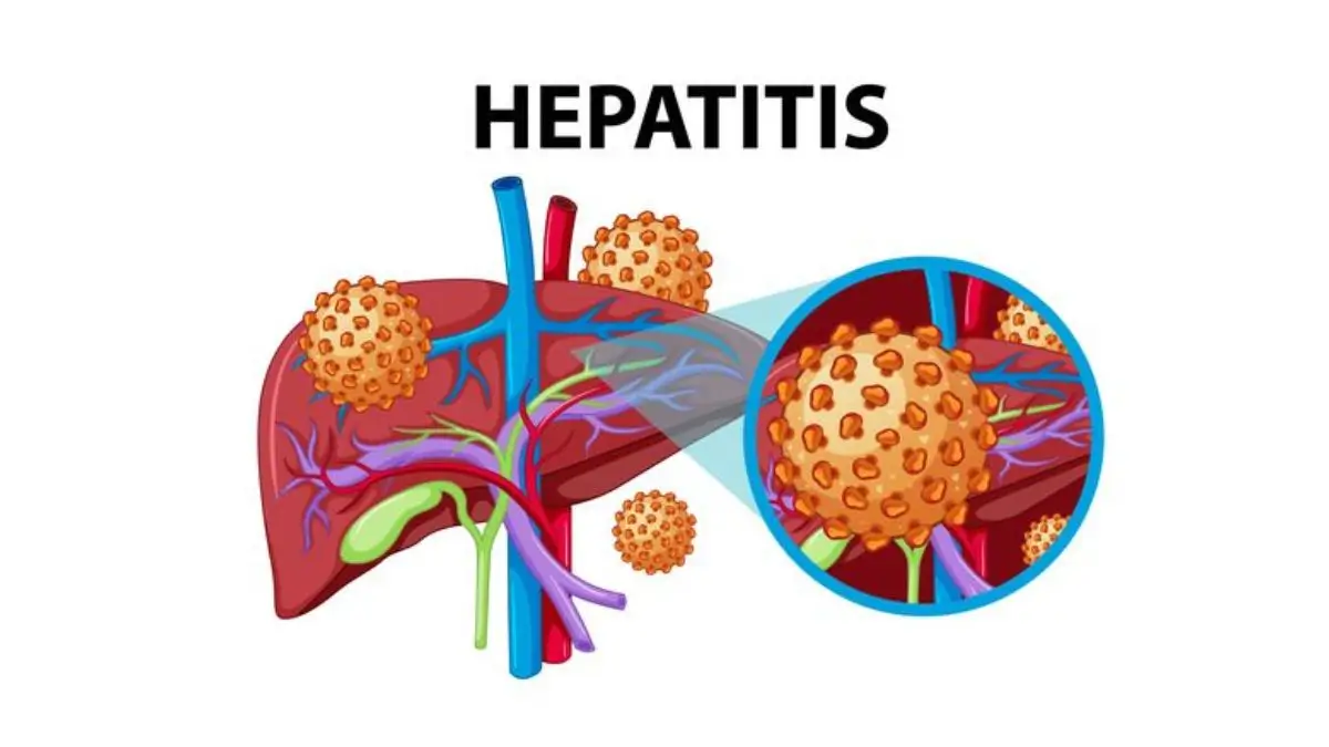 Hepatitis Elimination by 2030: India Outlines Key Steps
